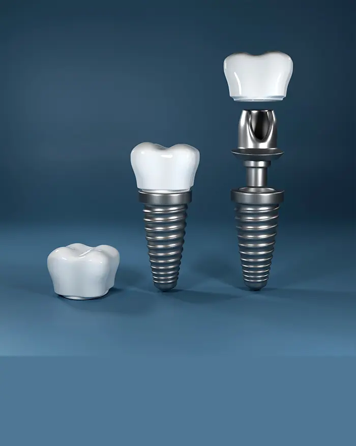 İmplant Tedavisi